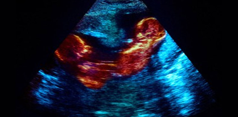 Hospital César Cals realiza primeira cirurgia fetal do Ceará