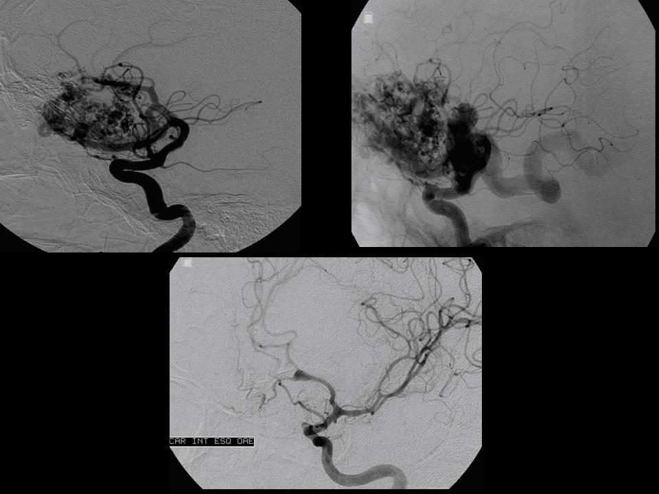 Tratamento de ponta para ANEURISMA CEREBRAL pelo SUS