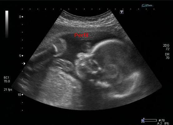 Hospital César Cals realiza primeira cirurgia fetal do Ceará