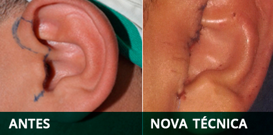 Nova técnica cirúrgica preserva estética do paciente no HGF