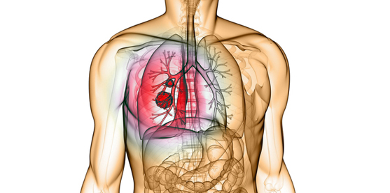 Câncer de Pulmão – Curso de Atualização em Oncologia
